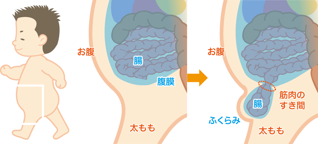 そけいヘルニア(脱腸)イラスト